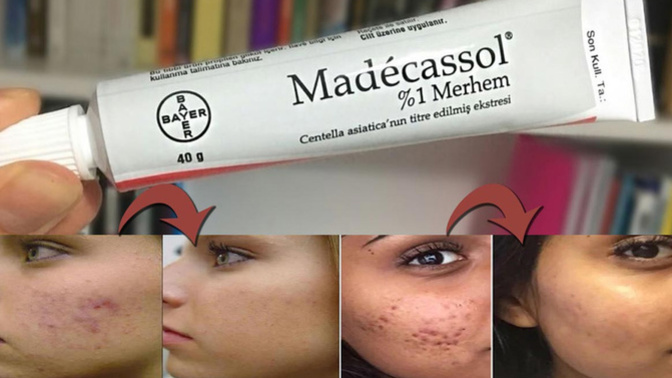 Madecassol krem nasıl kullanılmalı? Kortizon içeriyor mu?