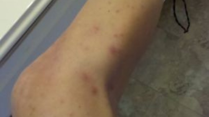 Özellikle bacaklarımda sivilceler çıkıyor doktora gittim yinede devam ediyor?