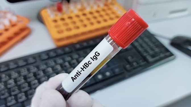 Anti HBS Nedir? 