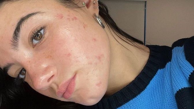 Derinin altındaki sivilceler nasıl geçer?