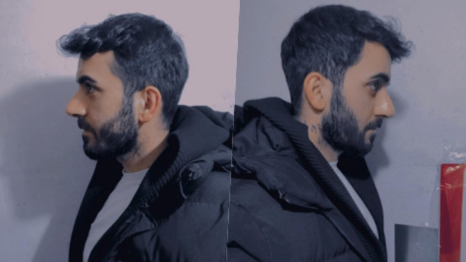 Burun estetiğimin 1. ayı! Sizce düzelir mi?
