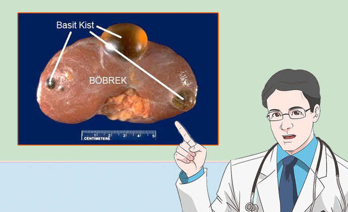 Böbreklerde oluşan kist tedavi süreci nasıl olur?