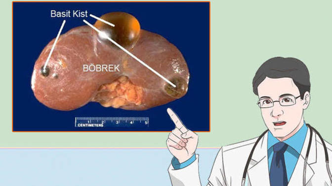 Böbreklerde oluşan kist tedavi süreci nasıl olur?