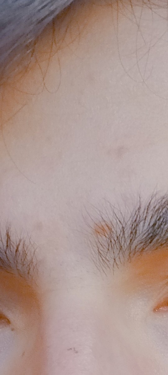 Bu izler nasıl geçer? Artmaması için nelere dikkat etmeliyim?