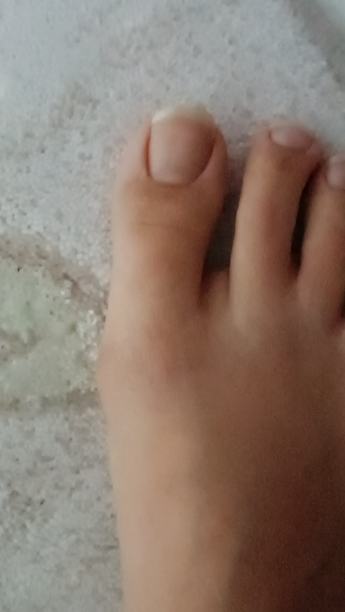 Ayak bas parmagi cikintisi?