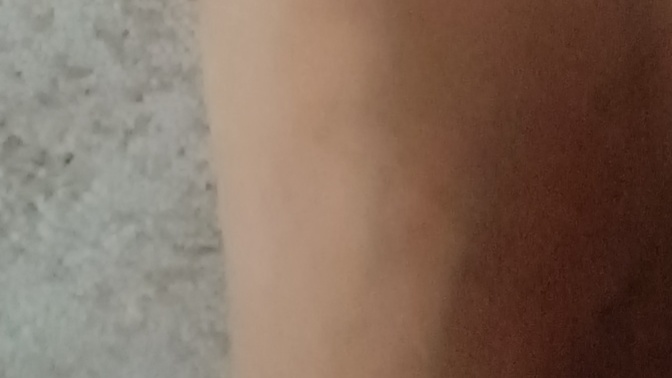Ayak bas parmagi cikintisi?