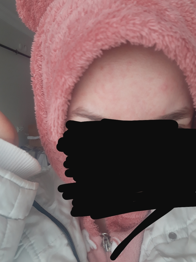Güneş kreminin cildimi bu hale getirmesi normal mi?