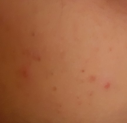 Yanaktaki sivilce ve siyah noktalara ne iyi gelir?
