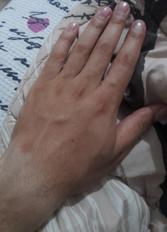 Soğuktan ellerimin rengi değişti, ne kullanmalıyım?