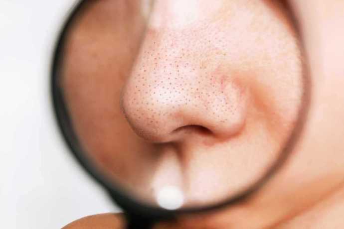 Siyah noktalardan kurtulmak için en etkili yöntem nedir?