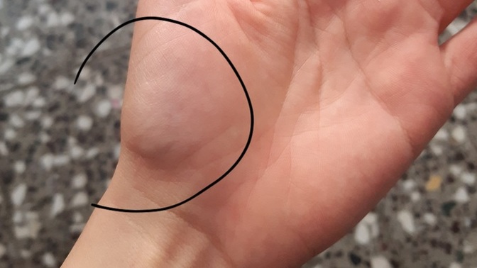 Belli olmuyor ama tam bu kısımlar morarmış gibi duruyor. Bir sıkıntı falan da olmadı, neden olabilir?