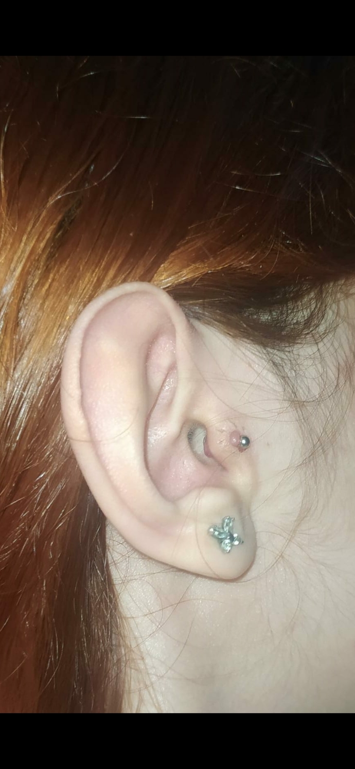Tragusumda sanırım keloid çıktı?