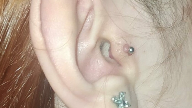 Tragusumda sanırım keloid çıktı?