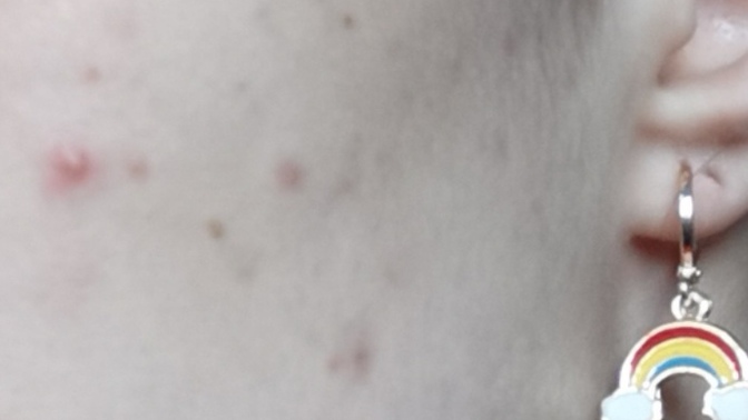 Yüzümde çok mu sivilce var, ilk defa bu kadar çıkıyor :(?