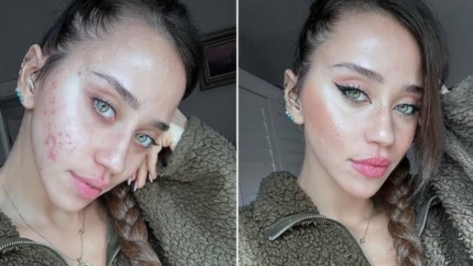 Partnerinizin sivilceleri olması sizin için sorun mu?