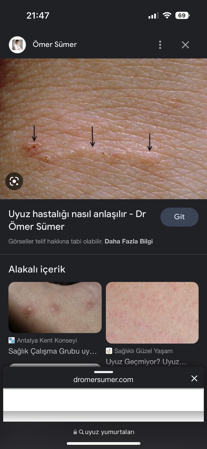 Geçmeyen uyuza ne önerirsiniz?