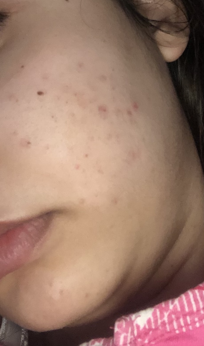 2 yıldır sivilcelerim geçmiyor tavsiyeniz nedir 🥺 doktora defalarca gittim işe yaramadı?