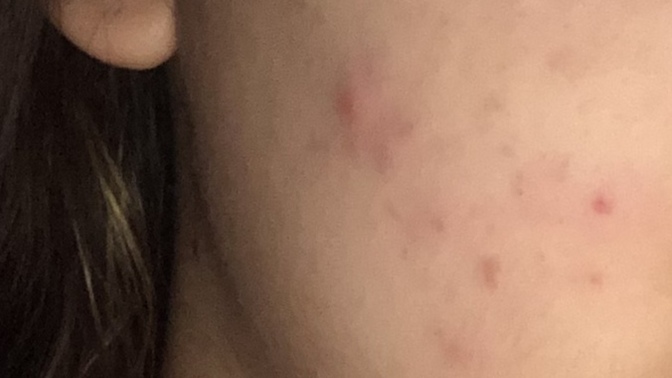 2 yıldır sivilcelerim geçmiyor tavsiyeniz nedir 🥺 doktora defalarca gittim işe yaramadı?