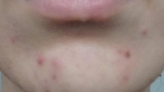 2 aydır sivilce tedavisi görüyorum ama durum bu. Bırakmalı mıyım?