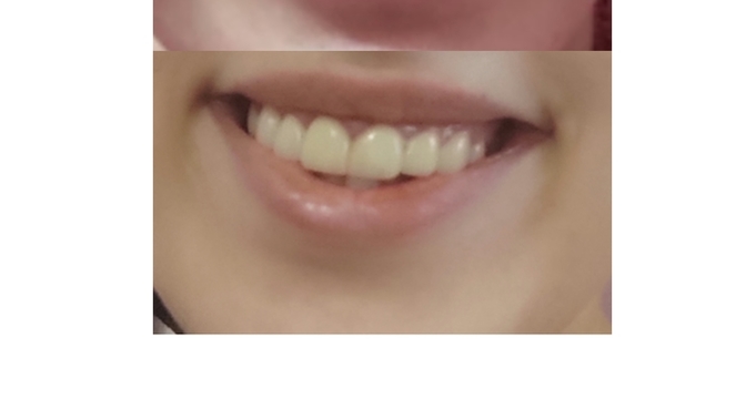Zirkonyum kaplama yaptırdım nasıl olmuş?