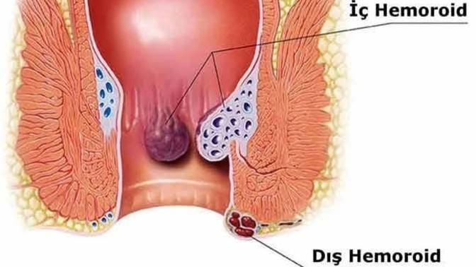 Basur memesi nasıl yok edilir dış kısımda olan hiç atlatan oldu mu?