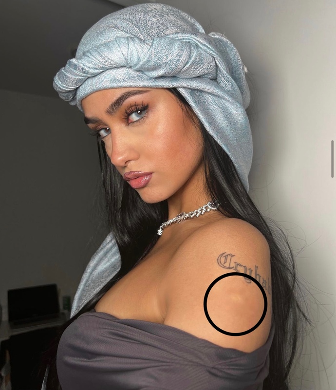 Neden insanların kolunda beyaz leke var?