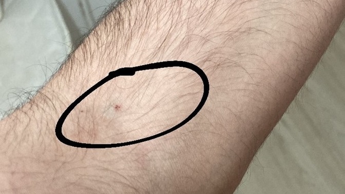 İğneden sonra kol şişmesi normal mi?
