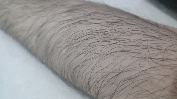 Buz lazer oldum! İliklerime kadar yandım, hani acımıyordu?