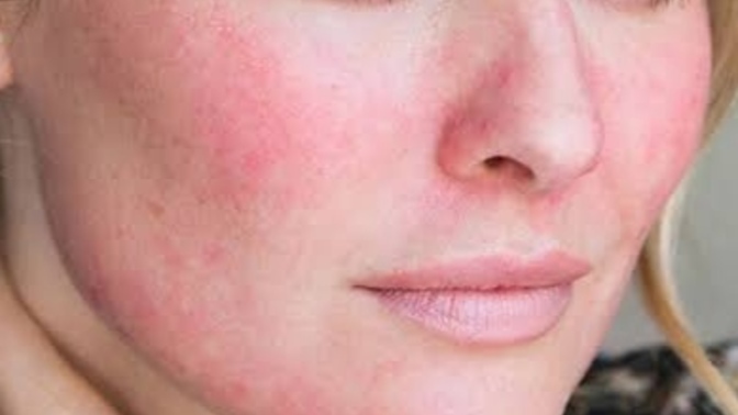 Facial blushing nasıl geçer?