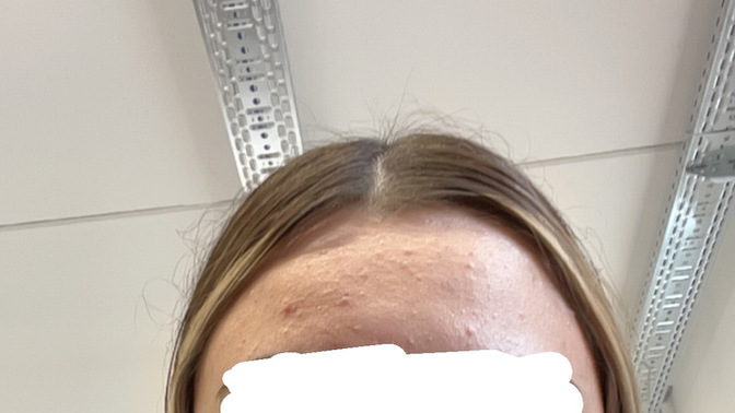 Yüzüm bu sekilde pütür pütür sanirsam komedonum veya fungal acnem var, siz gecmesi icin ne kullaniyorsunuz yardimci olun lütfen?