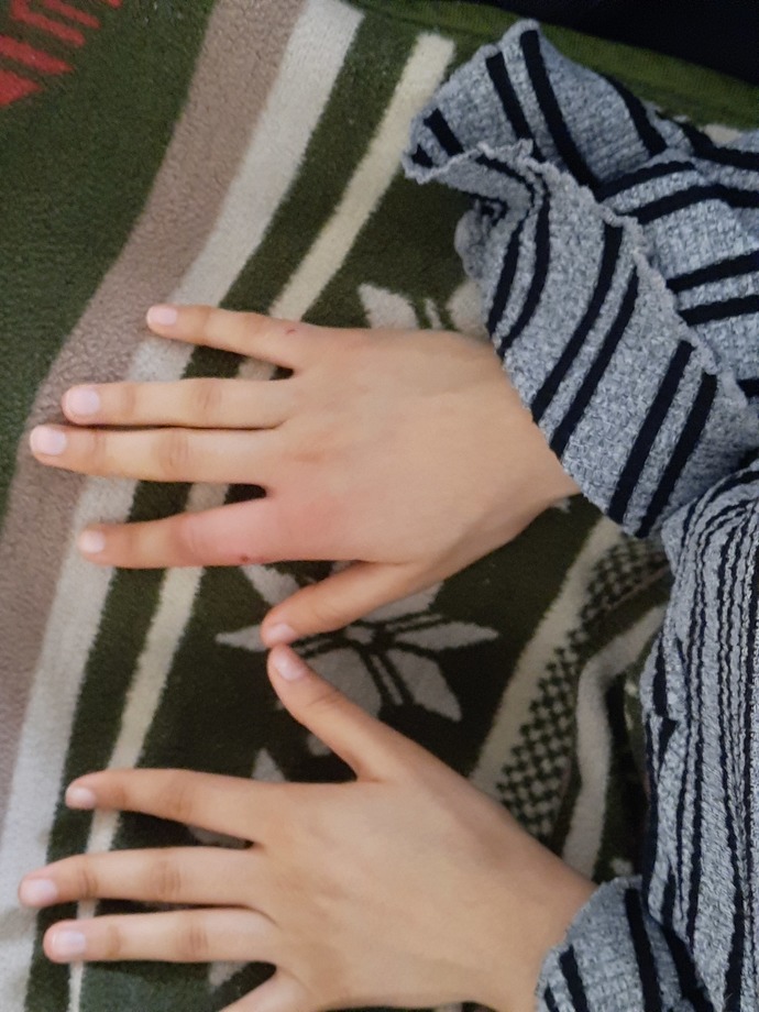 Parmağımı kedi ısırdı nasıl iner bu şiş?