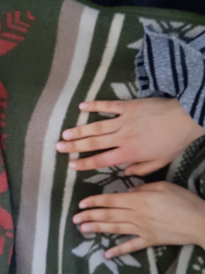 Parmağımı kedi ısırdı nasıl iner bu şiş?