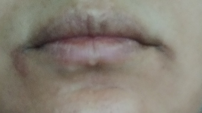 Dudaklarım şekilsiz ve kenar kısımları renksiz. Sizce sebebi ne olabilir ve nasıl düzelir?