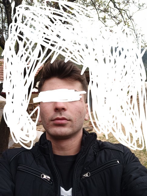 Bu sivilce izleri nasıl geçer?