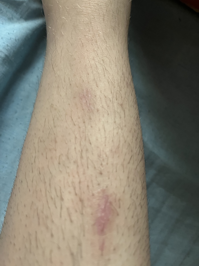 Bacaklardaki yaralar nasıl geçer?