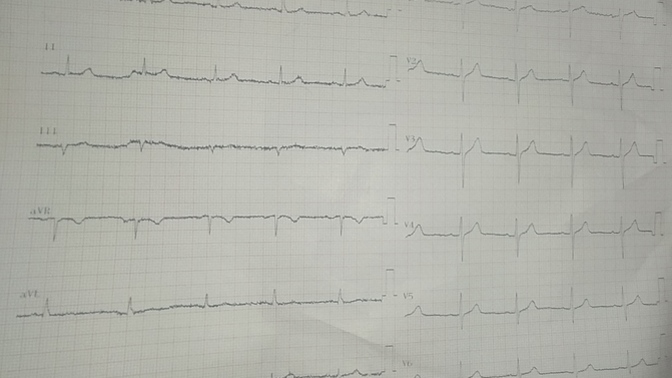 Arkadaşlar kalp grafiğinden anlayan varsa resime bakıp yardımcı olabilir mi ?