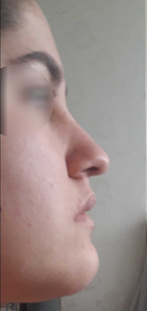 Bütün arkadaşlarım 20- 30 bin gibi paralara burun estetiği oldu. Ben de yaptırayım mı?