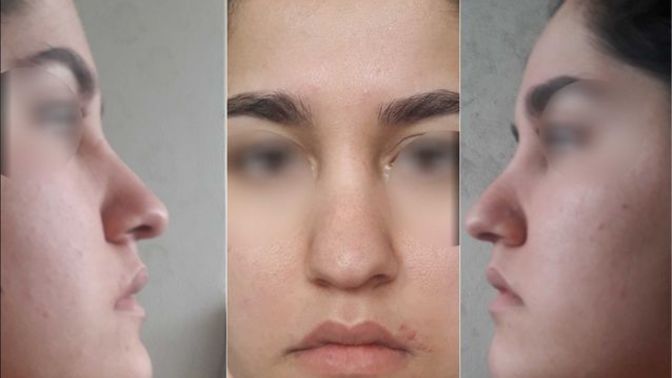 Bütün arkadaşlarım 20- 30 bin gibi paralara burun estetiği oldu. Ben de yaptırayım mı?