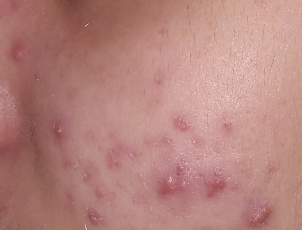 Bunun için doktor roaccutane verir mi?