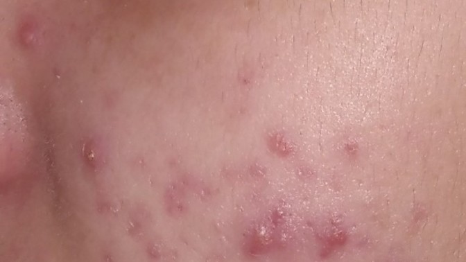 Bunun için doktor roaccutane verir mi?