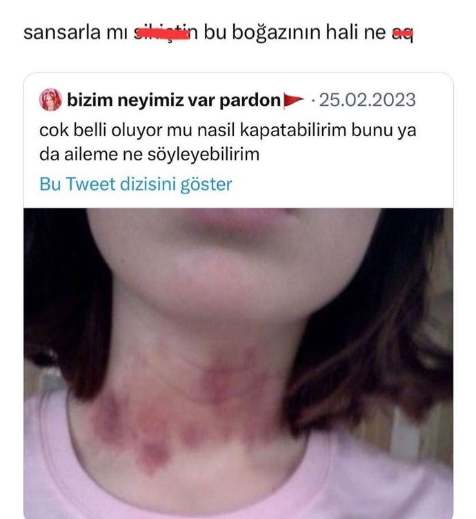 Çok sert bir sevişme sonrası boynunuzda morarma olursa ne yaparsınız?