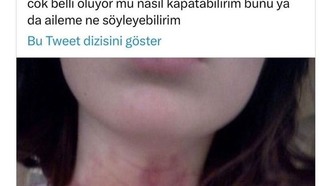 Çok sert bir sevişme sonrası boynunuzda morarma olursa ne yaparsınız?