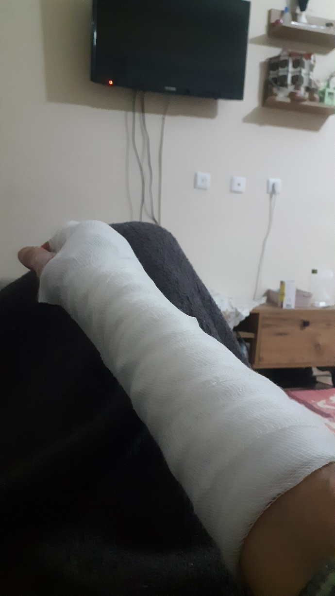 Hiç kolunuz ya da vücudunuzda bi yer kırıldı mı hayatınız boyunca?
