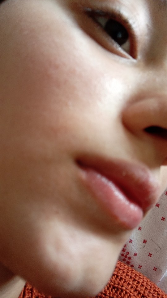Dün dolgu yaptırdım, şu an dudağım bu halde. Ne yapacağım?