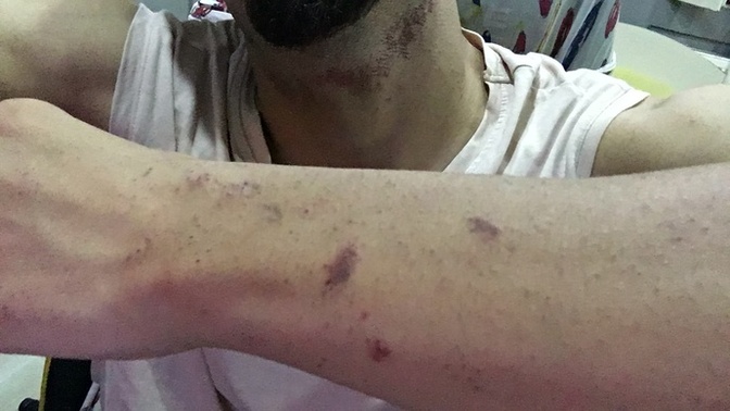 Lazer epilasyon yapalım dedik?