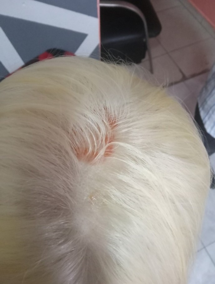 Saç beyaz/platine boyanınca saç derisinde bu yaraların olması normal mi?