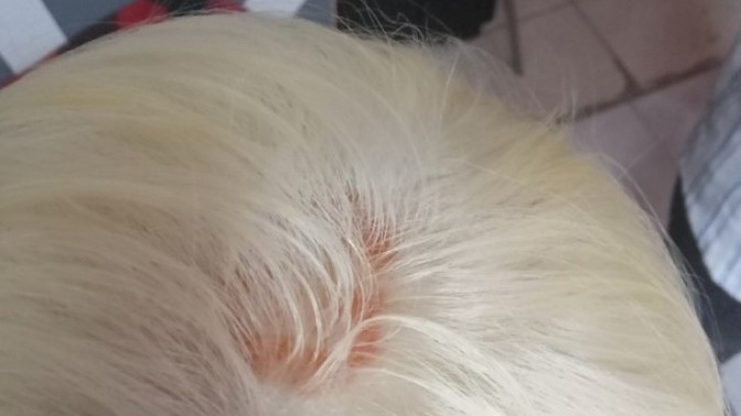 Saç beyaz/platine boyanınca saç derisinde bu yaraların olması normal mi?