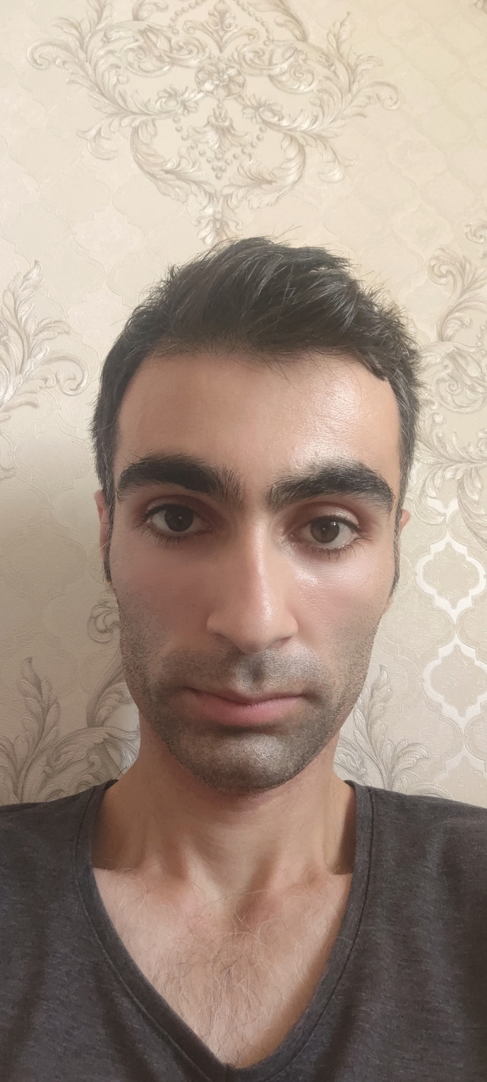 Saçımın ön hissesi seyrerlik oluşuyor hem de tarak bile vuramıyorum dökülür diye dikkat ediyorum sizce bir çare var mı?