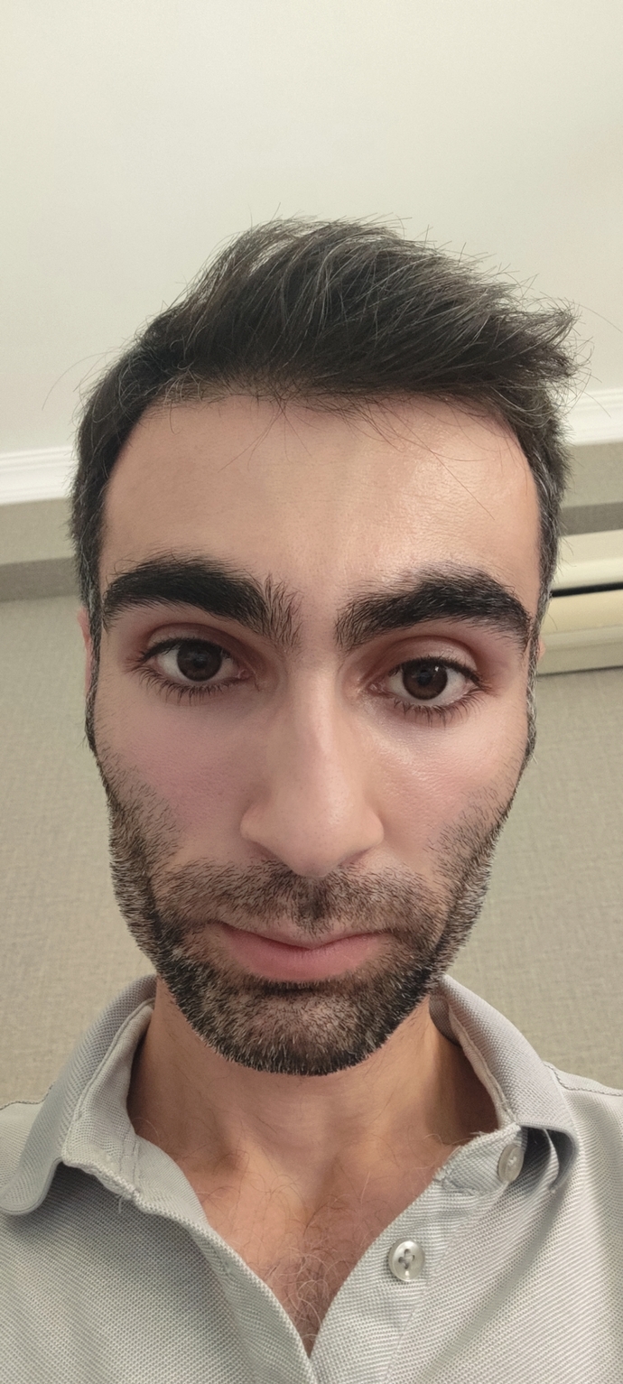 Saçımın ön hissesi seyrerlik oluşuyor hem de tarak bile vuramıyorum dökülür diye dikkat ediyorum sizce bir çare var mı?
