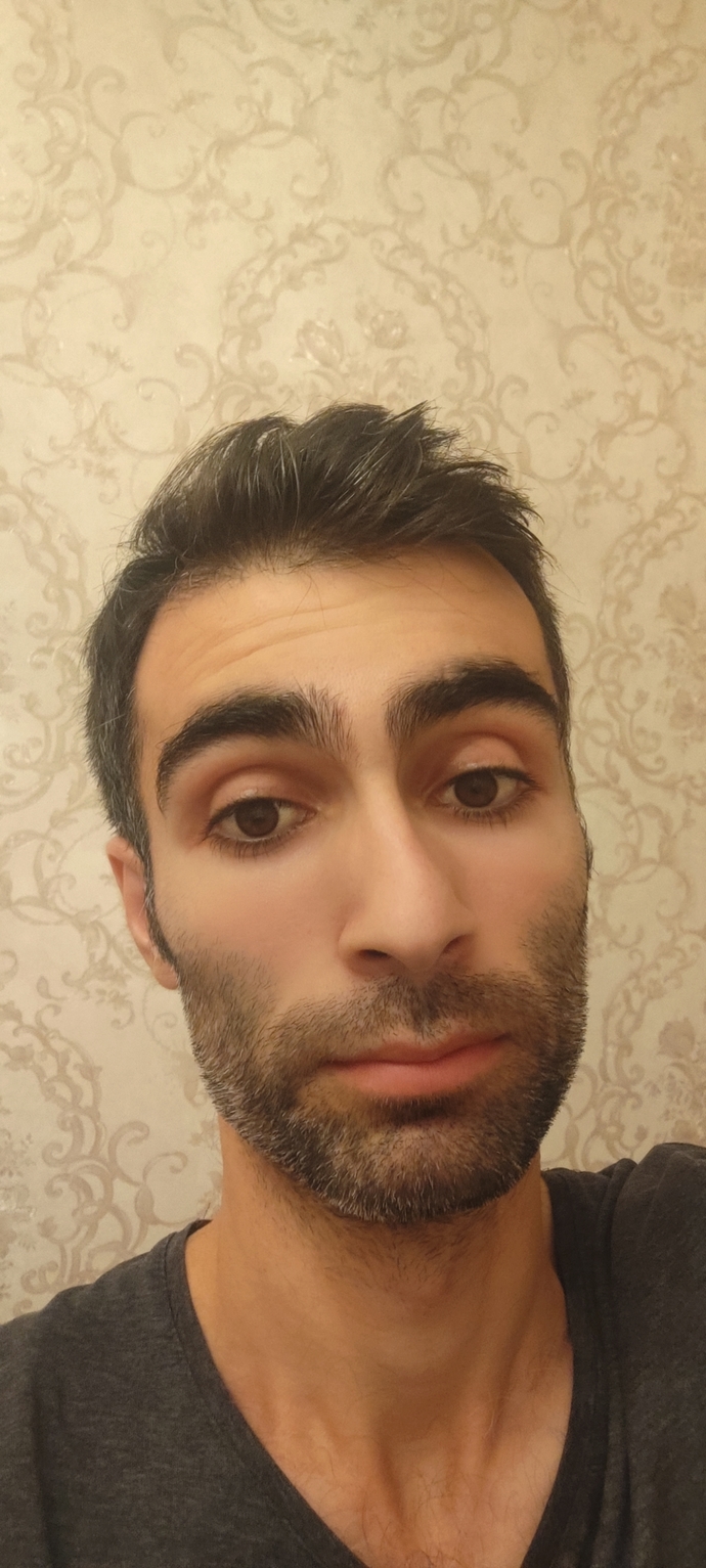 Saçımın ön hissesi seyrerlik oluşuyor hem de tarak bile vuramıyorum dökülür diye dikkat ediyorum sizce bir çare var mı?